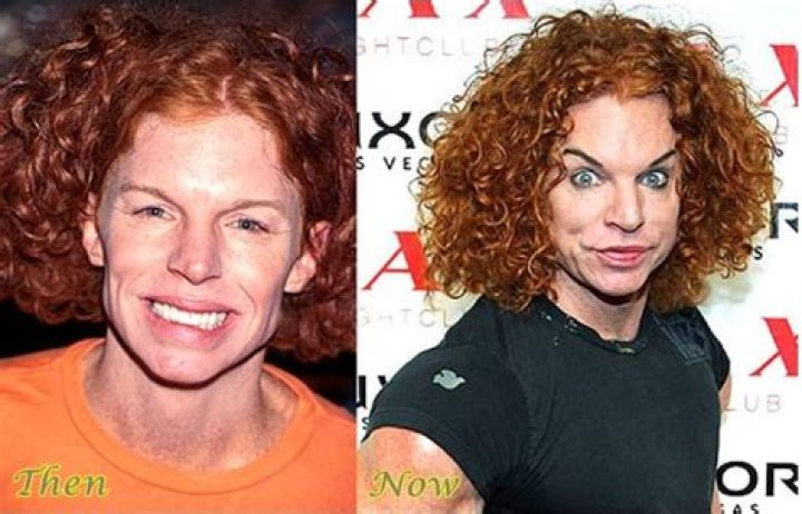 Carrot Top Plastic Surgery: Changing Lifestyle or An Excessive Surgical Transformation!