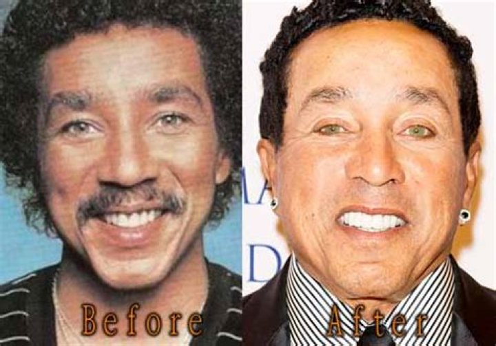 Smokey Robinson Plastic Surgery: Did He Go Under the Knife?